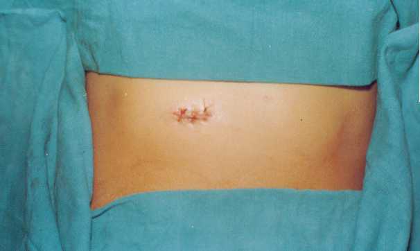 Gall Bladder Incision Closed